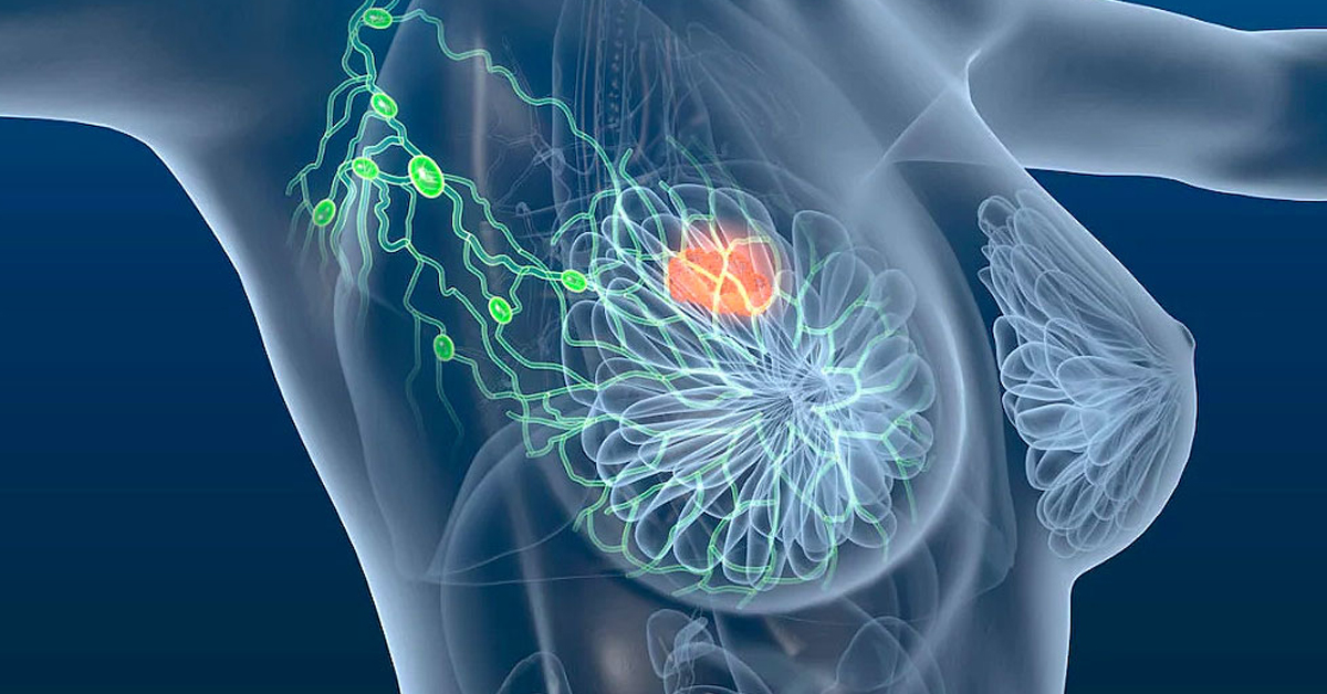 Espírito Santo registrou 501 novos casos de câncer de mama